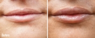 Juvederm-beforeafter2