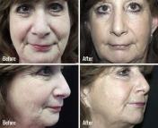 microneedling-before-after-1