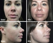 microneedling-before-after-2