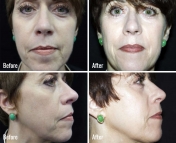 microneedling-before-after-3
