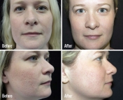 microneedling-before-after-4