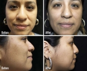 microneedling-before-after-5