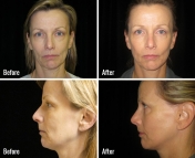 skin-rejuvenation-1