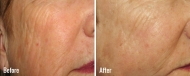 skin-rejuvenation-2
