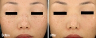 skin-rejuvenation-3